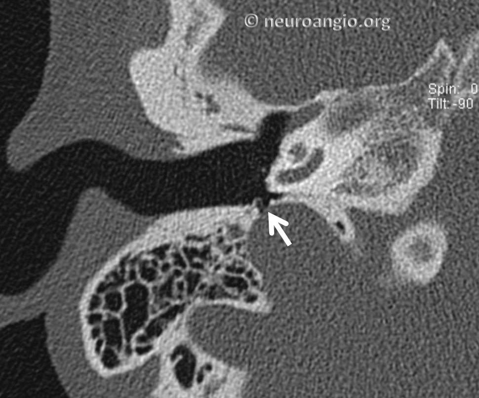 Pulsatile Tinnitus Jugular Plate Dehiscence